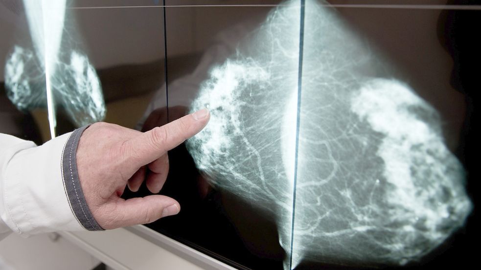 Früherkennung ist beim Thema Brustkrebs wichtig. Foto: Karmann/dpa/Archiv