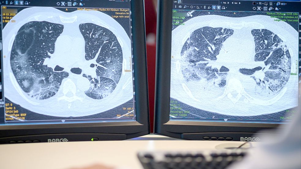 Computertomographieaufnahmen der Lunge eines Covid-Patienten. Foto: Sebastian Gollnow / dpa