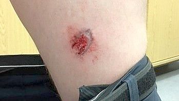 Die Bisswunde am Bein des Mannes. Foto: Bundespolizei