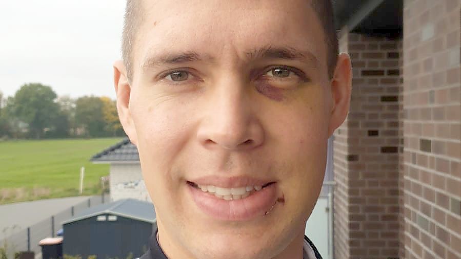 Henning Röbke kann wieder lächeln, die Schwellung ist weitestgehend abgeklungen. Foto: privat