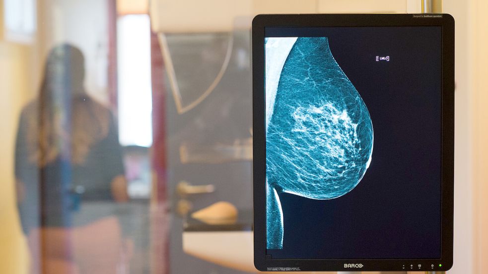 Krebs-Früherkennung: Die Brust einer Frau ist auf einer Röntgenaufnahme zu sehen. Foto: Gabbert/dpa