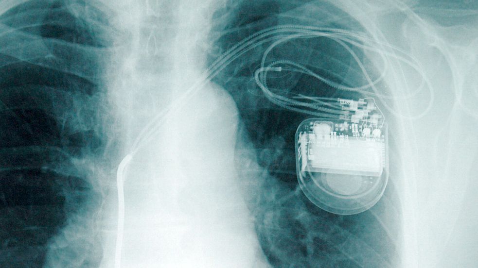 Wenn die Batterie eines Herzschrittmachers nicht mehr funktioniert, muss bisher durch eine Operation eine neue eingesetzt werden. Foto: dpa/Stefan Sauer