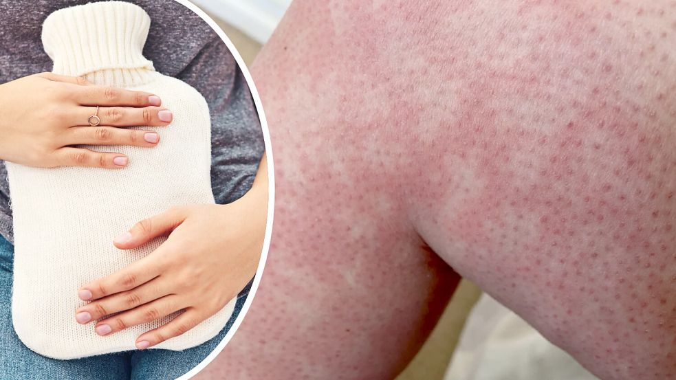 Wie eine Wärmflasche zum Hautproblem wird: Ursachen und Prävention des „Toasted-Skin-Syndroms“. Foto: IMAGO/peopleimages.com/Depositphotos
