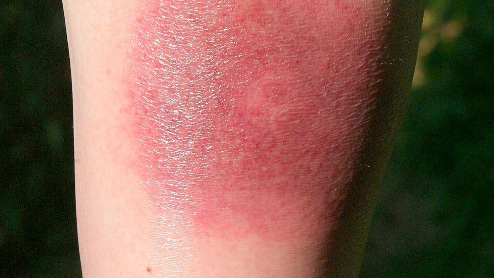 Klares Warnzeichen für Borreliose: Die sogenannte Wanderröte kann Tage oder Wochen nach einem Zeckenstich auftreten. (Archivbild) Foto: Harry Melchert/dpa/dpa-tmn