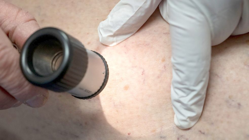 Die Zahl der Krankenhausbehandlungen von Hautkrebs stieg enorm an. (Symbolbild) Foto: Peter Kneffel/dpa