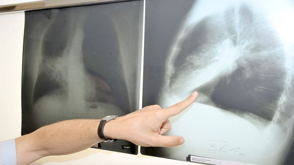 Ein Arzt zeigt auf ein Röntgenbild von einer von Krebs befallenen Lunge. (Illustration) Foto: Felix Hörhager/dpa