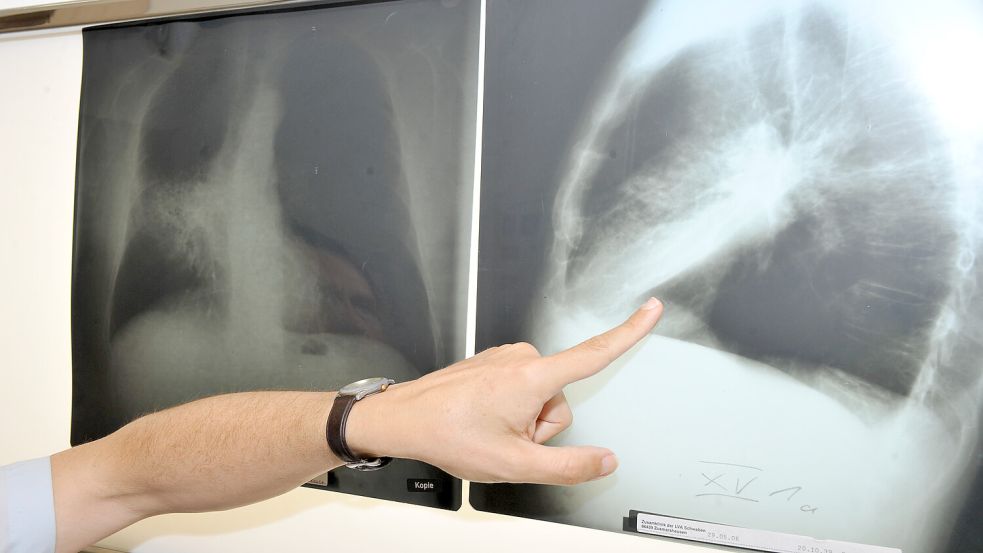 Ein Arzt zeigt auf ein Röntgenbild einer von Krebs befallenen Lunge. Bei einer verstorbenen Frau aus Emden hätten Ärzte im Klinikum den Krebs erkennen müssen, sagt ihre Tochter. Symbolfoto: Felix Hörhager/dpa