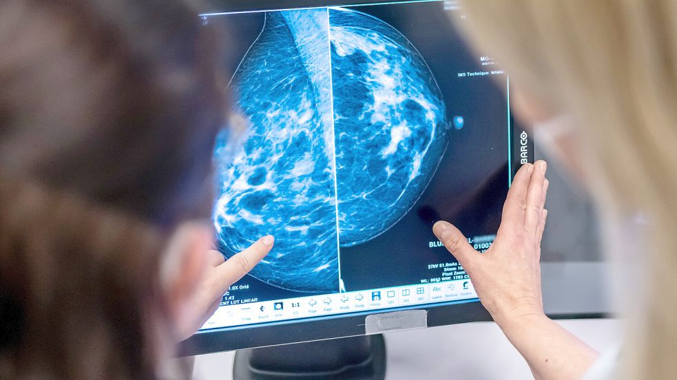 Brustkrebs? Laut Germanischer Neuer Medizin durch einen psychischen Schock verursacht. Eine lebensgefährliche Ansicht. DPA-Symbolfoto: Hannibal Hanschke