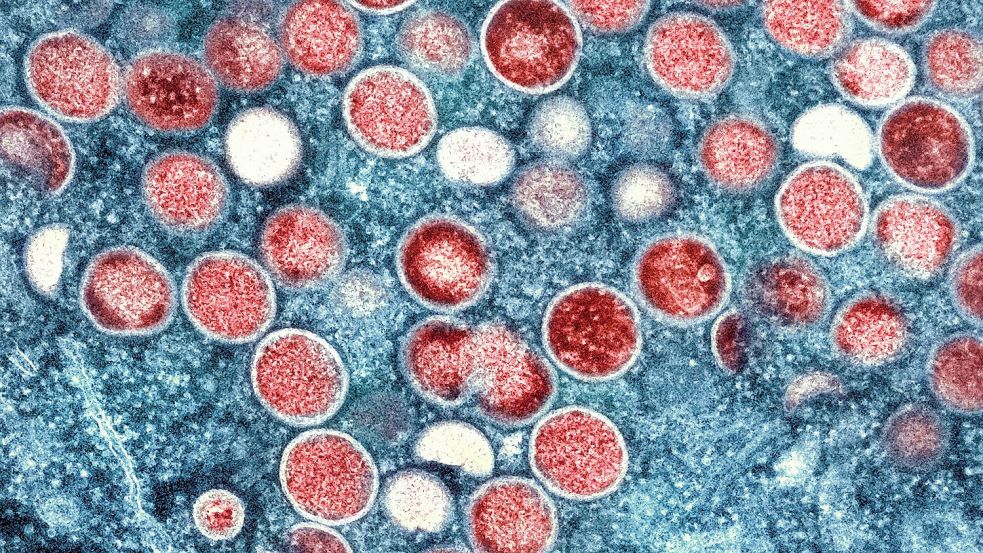 Beim Menschen wurden Mpox erstmals 1970 in der Demokratischen Republik Kongo identifiziert (Symbolbild). Foto: -/National Institute of Allergy