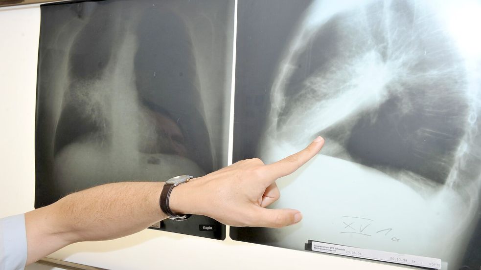 Ein Arzt zeigt auf ein Röntgenbild einer von Krebs befallenen Lunge (Illustration) Foto: Felix Hörhager/dpa