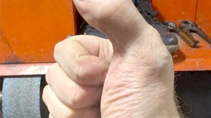 Nachdem Schuhmacher David Lee bei einem Arbeitsunfall seinen Daumen verlor, kamen die Ärzte auf eine ungewöhnliche Idee. Foto: David Lee