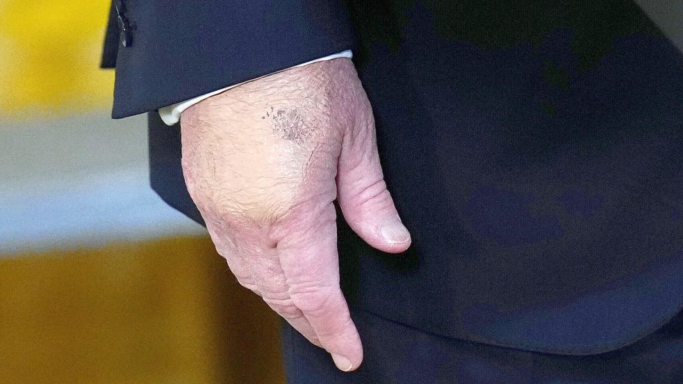 Donald Trump lässt sich stets seine „gute Gesundheit“ attestieren. Die Aufnahme seiner Hand von Anfang Mai 2026 zeigt jedoch Blutergüsse. Foto: picture alliance/dpa/AP | Jacquelyn Martin